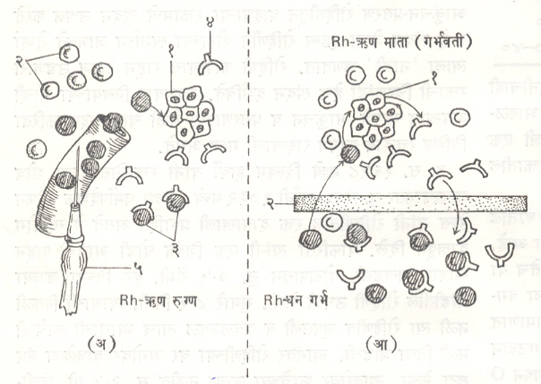  आ. २. Rh घटकामुळे उद्‌भवणाऱ्या प्रतिक्रिया : (अ) Rh — ऋण रुग्ण : (१) ऊतक कोशिका, (२) Rh — ऋण तांबड्या कोशिका, (३) Rh — धन तांबड्या कोशिका, (४) प्रतिपिंड, (५) दुसरे Rh — धन रक्ताधान (अंतःक्षेपण सुई रक्तवाहिनीत) (आ) Rh — ऋण माता (गर्भवती) व Rh — धन गर्भ : (१) ऊतक कोशिका, (२) वार.