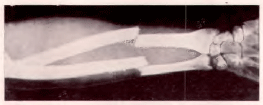 क्ष-किरण छायाचित्र : हाताच्या मोडलेल्या हाडाचे क्ष-किरण छायाचित्र.