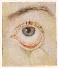 नेत्रश्लेष्मशोथातील अतिरक्तता-रक्तवाहिन्यांचे विस्फारण होऊन डोळा लाल दिसतो.