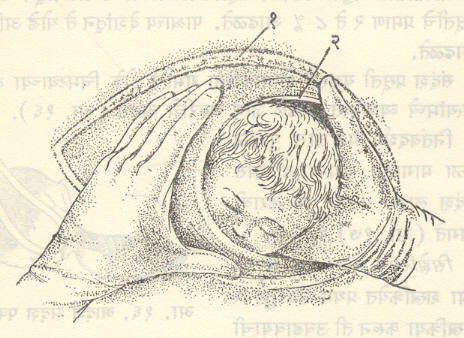 आ. १८. सिझेरियन छेदन : गर्भाशय छेदातून उजव्या हाताने केलेली डोक्याची प्रसूती : (१) उदर भित्तीचा छेद, (२) गर्भाशय भित्तीचा छेद. 