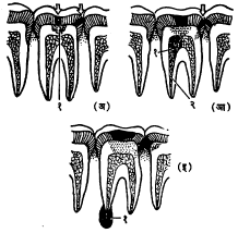 आ. ३. दात किडणे : (अ) दाताच्या किडीची सुरूवात : (१) खोल गेलेली कीड (आ) एका दाताची कीड शेजारच्या दातात पसरते : (१) किडलेला दंतगर,(२) दंतमूलातील कीड, (इ) कीड दंतगरात पलरून दंतमूलाच्या टोकाशी विद्रधी (गळू) बनतो : (१) विद्रधी (वरील आकृतीत काळा भाग कीड दर्शवितो).