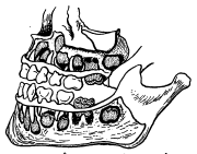 आ. १०. सहा वर्षांच्या मुलाच्या जबड्यातील दात कायमचे दात निराळे (त्यांवरील ठिपक्यांच्या साहाय्याने) दाखविले आहेत.