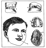 आ. ११. चोखणीमुळे होणारे दुष्परिणाम : (१) मुलाचे वाकडेतिकडे दात (बाजूकडून), (२) वाकडेतिकडे दात (पुढून), (३) चांगले दात (वरच्या जबड्यातील), (४) वाकडेतिकडे दात (वरच्या जबड्यातील), (५) मुलाच्या वरच्या व खालच्या दातांमध्ये वाकडेतिकडेपणामुळे पडलेली फट.