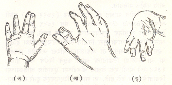 आ. ३९. (अ) संयुक्तांगुल (आ) द्विगुणित आंगठा (इ) अविकसित आंगठा व अरास्थी.
