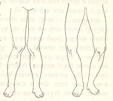 आ. ३. पायांतील लांब हाडांच्या वक्रतेमुळे उद्‌भवणाऱ्या विकृती : अंतर्नत जानू (डावीकडील) व बहिर्नत जानू (उजवीकडील).